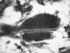 M,76y. | septate junctions between degraded organelles - mesothelioma